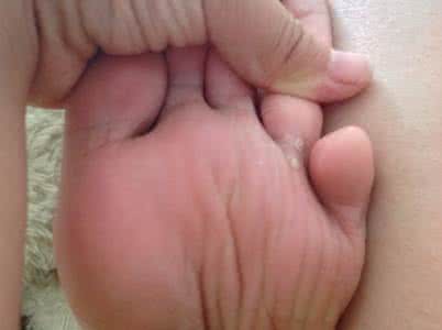 脚气病 脚气不同于脚气病:附药方
