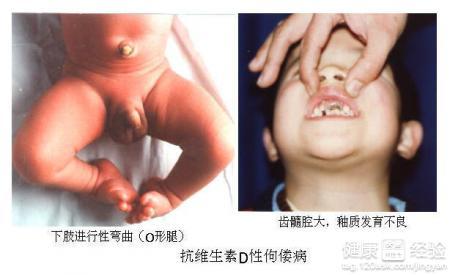 佝偻病治疗方法 佝偻病能治好吗 治疗的方法有哪些