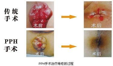 内痔疮的最佳治疗方法 长痔疮怎么办 痔疮的治疗方法有哪些 ?