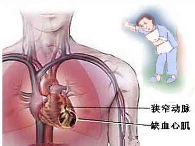 内因外因 心绞痛的原因 内因外因要分清