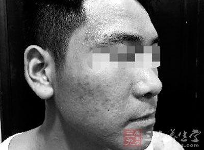 苗方清颜祛痘价格表 苗方清颜祛痘顾客险毁容 医院诊断接触性皮炎