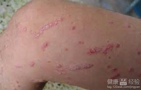 银屑病又快又好的偏方 银屑病偏方  还你一身光洁皮肤