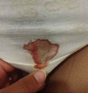 排卵期出血治疗方法 排卵期出血治疗方法 排卵期出血量及治疗方法