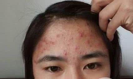 面部螨虫怎么去除 去除面部螨虫 怎么去除面部螨虫？