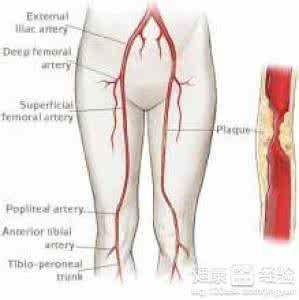 下肢动脉栓塞治疗 动脉栓塞 如何治疗动脉栓塞