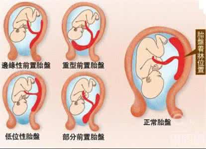 胎盘后壁的优点 胎盘后壁是什么意思