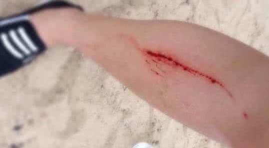梦见身上有伤口 梦见身上有伤口 梦见伤口