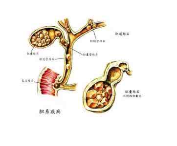 胃病断根绝技秘方 不传秘方:胆结石两周断根威灵金钱汤