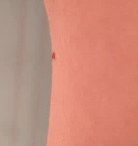 身上长小肉粒 身上长小肉粒 究竟是因为什么