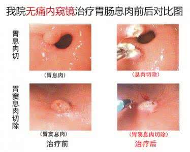 胃息肉的治疗方法 胃息肉治疗方法 胃息肉治疗 治疗胃息肉的方法有哪些