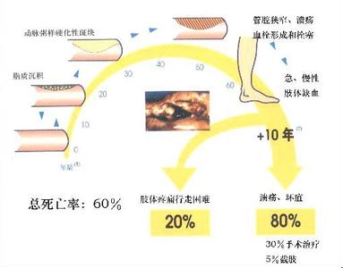 中医治疗脉管炎 脉管炎要截肢?太可怕!看看中医治疗优势所在