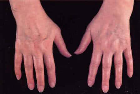 类风湿关节炎症状表现 类风湿关节炎症状表现 关节炎的症状都有哪些表现？