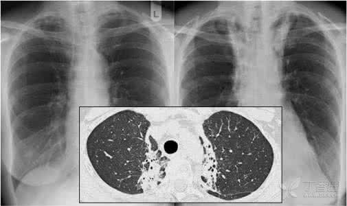 放射性肺炎的症状 放射性肺炎 放射性肺炎的表现是什么