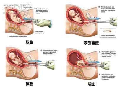 哪种流产对身体伤害小 流产对身体有什么影响 流产对身体的伤害