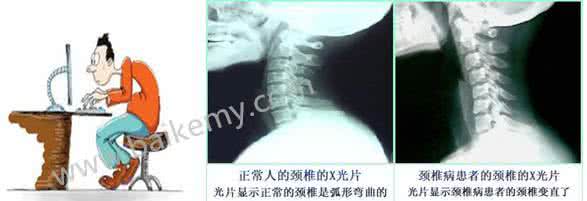 颈椎康复 【转】颈椎康复,绝方!