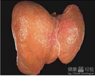引起脂肪肝的原因 重度脂肪肝 引起重度脂肪肝的原因