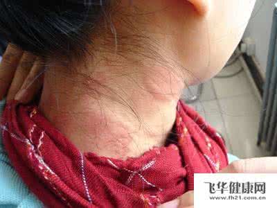 神经性皮炎的饮食禁忌 神经性皮炎 神经性皮炎的饮食禁忌