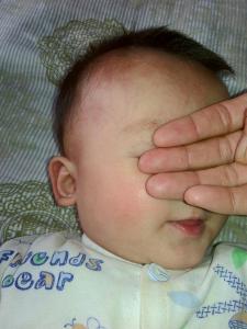 宝宝出疹子症状 宝宝发烧后出疹子怎么办？发烧后出疹子的症状