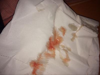 脸上的红血丝怎样处理 为什么精液里有血丝 如何处理