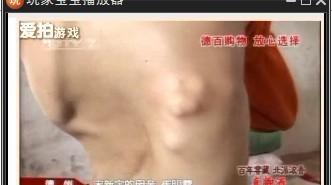 早期复极综合征心电图 成人早老综合征 是什么导致了成人早老