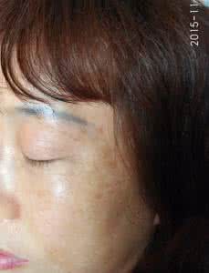如何去掉面部色斑 15种食物帮助女性去掉面部色斑