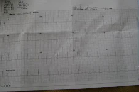 边缘心电图是什么意思 边缘心电图有什么影响？