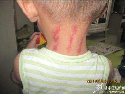 小儿吮痧图解 吮痧——防治小儿风寒感冒初起_中医路新宇