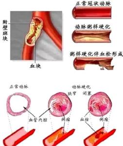 全身血管堵塞 血管堵塞后的中药方 【转载】全身各部血管堵塞中药方