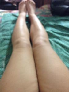 小腿粗该怎么办 治疗腿不等粗 小腿粗该怎么办