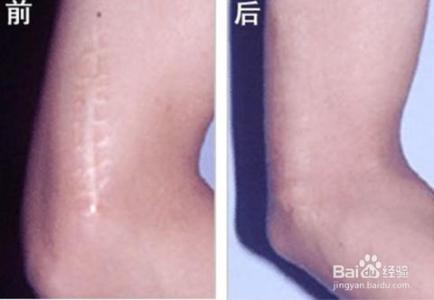 如何淡化疤痕 如何淡化疤痕 中医如何淡化疤痕