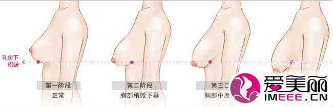 乳房下垂松软怎么办 乳房下垂怎么整形 如何预防乳房下垂