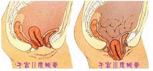 年底处女膜修复增多 年底压力突然增多怎么办