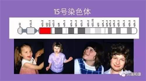 低t3综合征的病因 天使综合征 天使综合征的病因