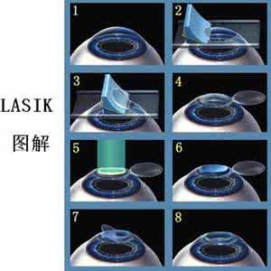 近视眼手术的种类 常见的近视眼的种类有哪些