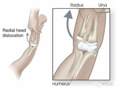 肘关节脱位表现 肘关节脱位 肘关节脱位有什么样的表现