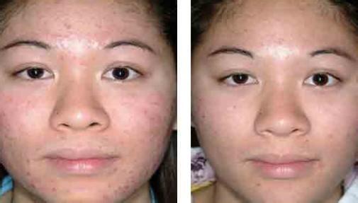 激光祛痘大概要多少钱 祛痘要多少钱 激光祛痘的呢