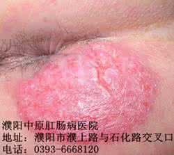 鸡蛋黄油治湿疹吗 引用 【转载】【图解】黄油治湿疹、痔疮有特效