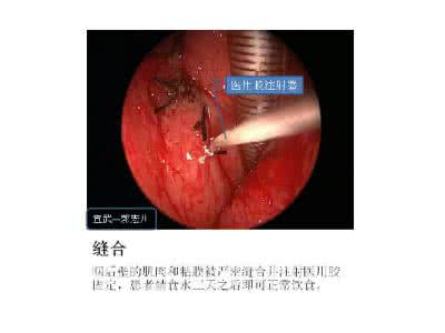 咽旁间隙肿瘤 咽旁间隙肿瘤的诊断和治疗