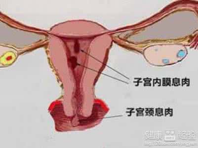 中医治疗子宫内膜息肉 中医治疗子宫内膜息肉 子宫息肉不治疗会怎样？