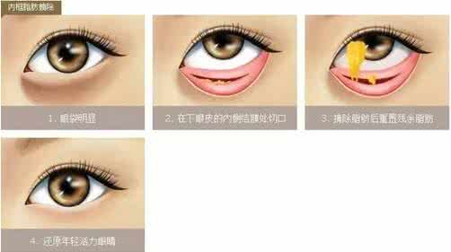 不手术祛眼袋的方法 祛眼袋手术价格 内路法祛眼袋手术特点