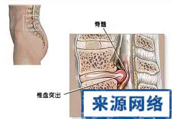 腰间盘突出引起腿疼怎么办 孕妇腰间盘突出怎么办