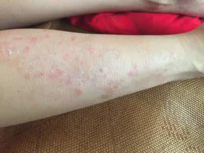 夏天容易得那些皮肤病 夏天容易得的皮肤病有哪些?
