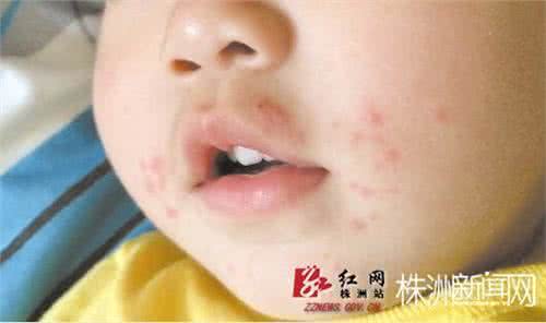 脸上长红疹是什么原因 脸上长红疹是什么原因 小儿红疹的原因有哪些