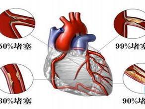 引起冠心病的原因 冠心病是什么 冠心病是什么原因引起的