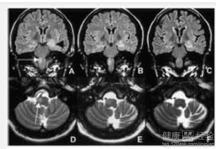 小脑萎缩的中医治疗 小脑萎缩的治疗 中医如何治疗小脑萎缩