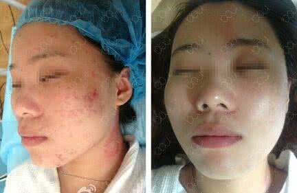 特级护理适用于 复方痤疮平适用于什么情况 如何护理痤疮