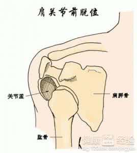 胯关节脱位 急救常识 小儿胯关节脱位该怎么办