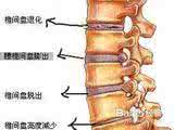 腰椎间盘突出土方治疗 根治腰椎间盘突出的土方子！赶快收藏！