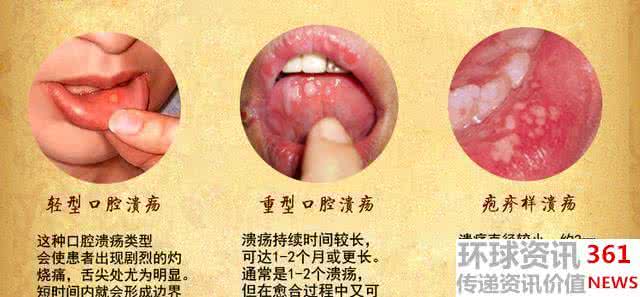 口腔溃疡 免疫系统 口腔溃疡 免疫系统 口腔溃疡，原来是一场免疫之战！