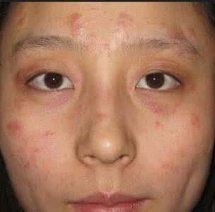 季节性湿疹如何治疗 季节性湿疹 季节性湿疹如何防治